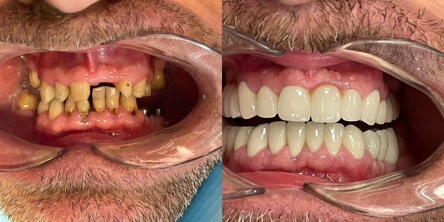Case 03 real patient before and after dental treatment